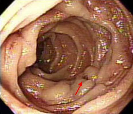 () Upper endoscopy shows marked bead-shaped variceal change in the second portion of the duodenum.