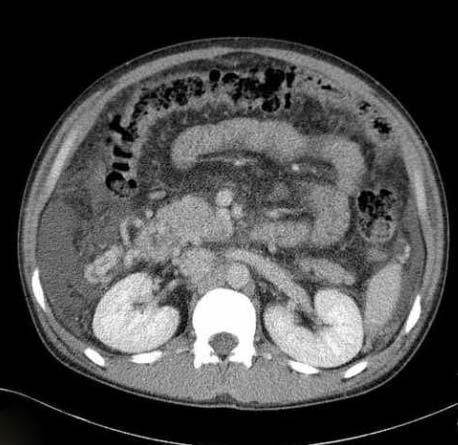 () bdominal CT shows duodenal varix and large ascites before treatment.