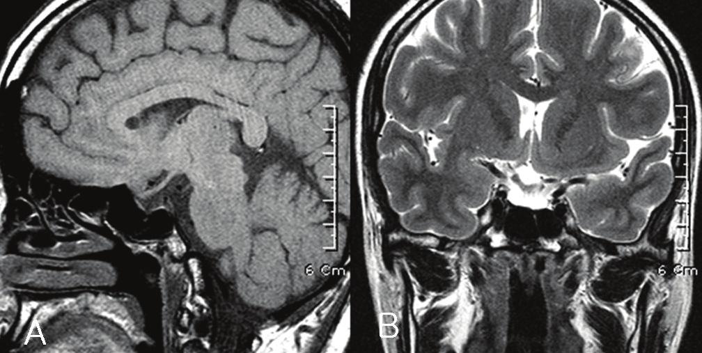 - The Korean Journal of Medicine: Vol. 75, No. 5, 2008 - Figure 1. Magnetic resonance imaging (MRI) of the sella turcica.