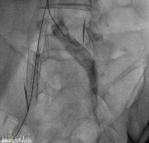 aorta. (B) A guide wire inserted through both femoral arteries was advanced in the false lumen.