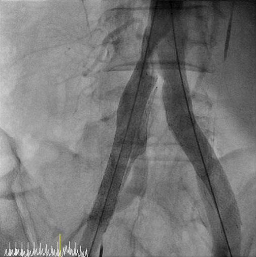 (D) The restoration of blood flow was not achieved in the right iliac artery after treatment with a self-expandable balloon stent
