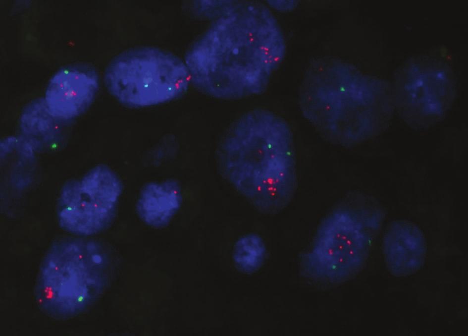 Demonstration of SISH vs FISH HER2 gene amplification status obtained from 58 consecutively examined invasive breast cancer cases HER2 gene SISH amplification status Negative Equivocal