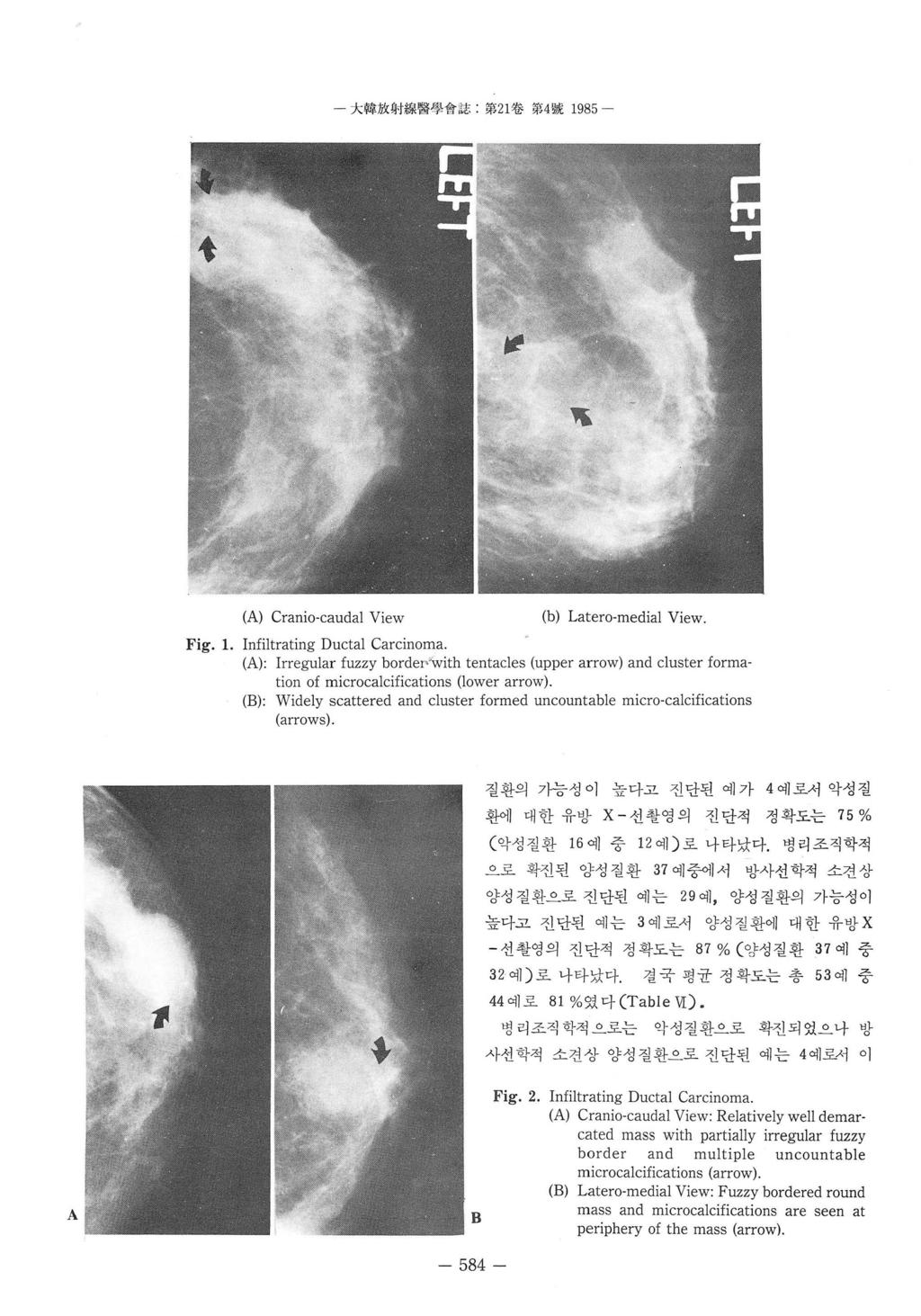 - 大합放射짧醫學會誌. 第 1 卷第 4 號 1985 - (A) Cranio-caudal View (b) Latero-medial View_ Fig_ L Infiltrating Ductal Carcinoma.