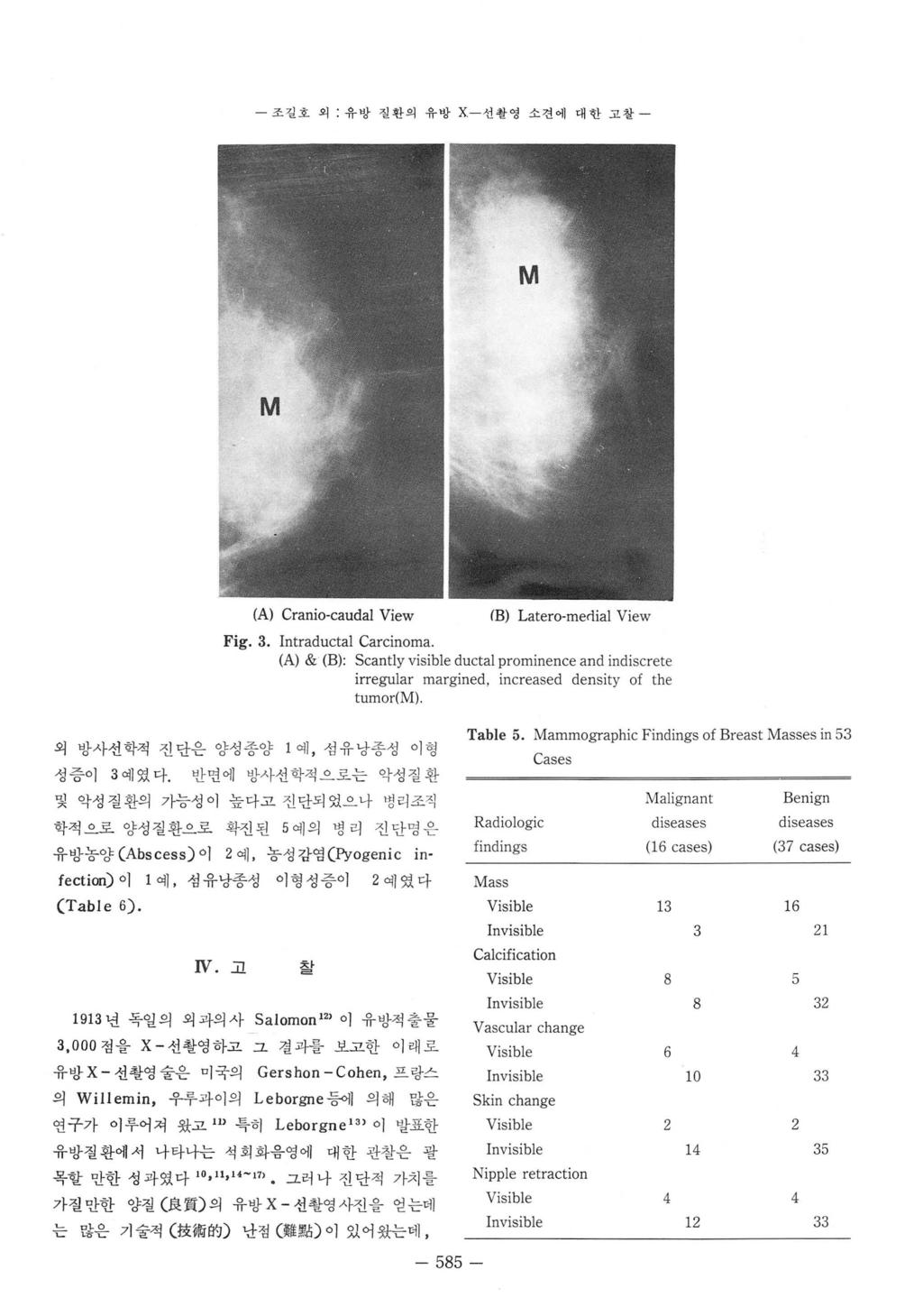 조길호외 : 유방질환의유방 x - 선촬영소견에대한고찰 - (A) Cranio-caudal View IB) Latero-mer!ial View Fig_ 3_ lntraductal Carcinoma.