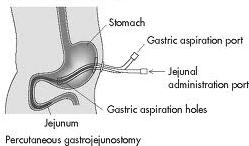 경장영양 (Enteral Feeding) 위조루의삽입방법이나형태에따라다음과같은종류가있다 그림 2. Gastrostomy 그림 3. uttongastrostomy 그림 4. Gastrojejunostomy 1.