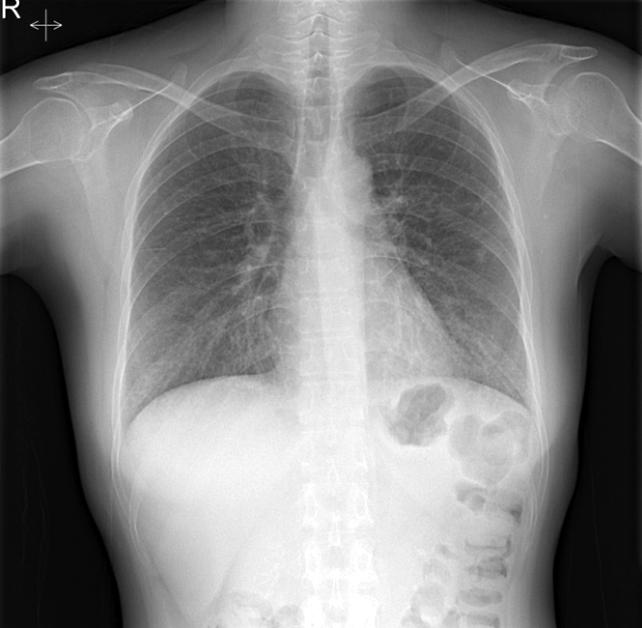 Dong Han Kim, et al: Late Onset Pneumocystis jirovecii Infection in a Renal Transplant Recipient 보고하는바이다.