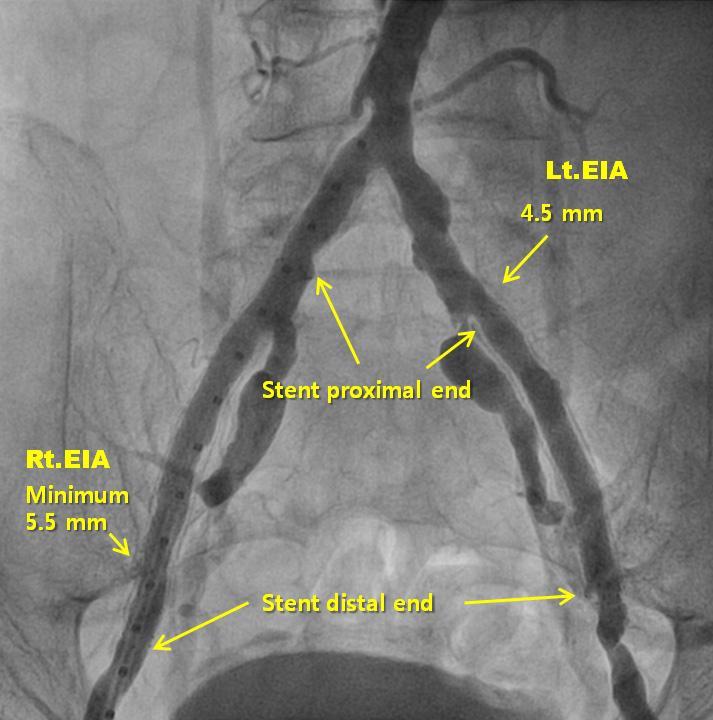 대한내과학회지: 제 85 권 제 2 호 통권 제 636 호 2013 A B C D Figure 1. The CoreValve delivery system was advanced through an 18 French (Fr) sheath inserted into the right femoral artery after PTA.