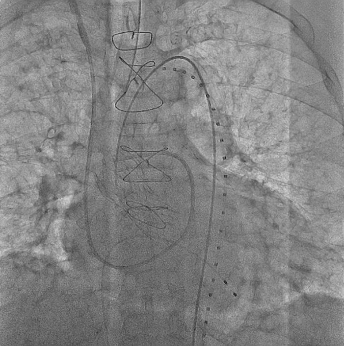 이동준 외 6인. 장골동맥협착 환자의 경피적 대동맥판 삽입술 A B Figure 2.