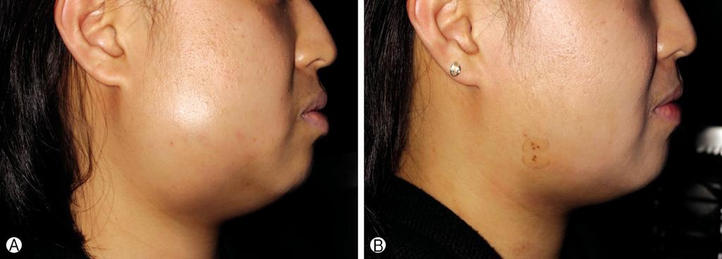 SC Park, et al. Effectiveness of US-guided Angiocatheter Aspiration, Irrigation and Drainage for Head and Neck Abscesses Table 2.