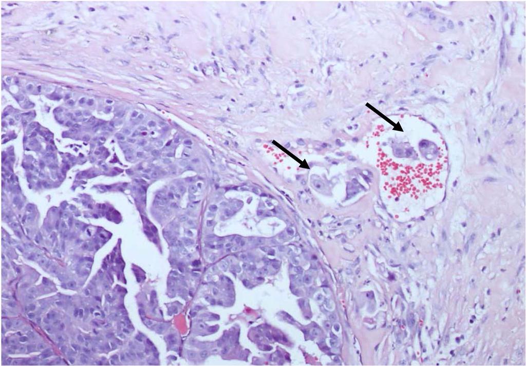 š 159 Fig. 3. Apocrine adenocarcinoma, dog. Note tumor cells emboli (arrows) in blood vessel. H&E, 200. Fig. 4. Apocrine adenocarcinoma, dog. Many tumor cells in neoplastic tubules show positive reaction for periodic acid-schiff (PAS) staining.