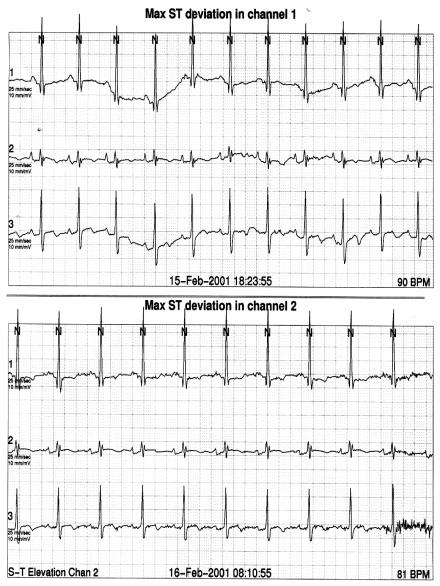 Case #3, M/51 Holter After