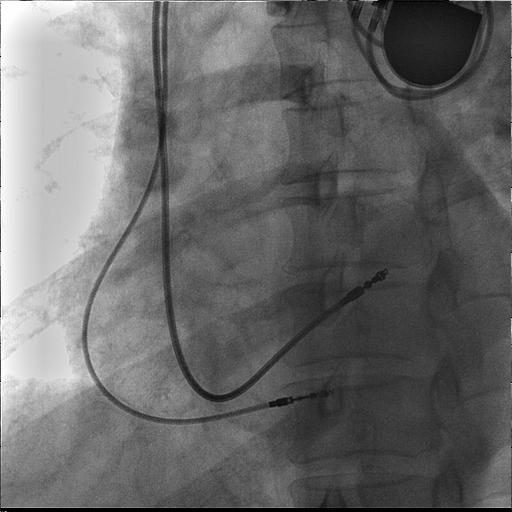 DDDR (Low Atrial