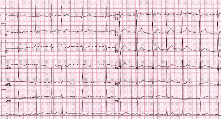 5, M/38 Recurred AF post-cv 4 months, Amiodarone