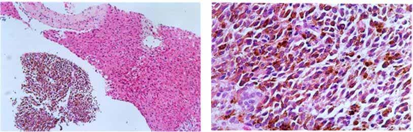 Microscopic findings of liver biopsy, showing plump cells with cytoplasmic melanin pigment and prominent nucleoli (Left: H&E stain, 100), (Right: H&E stain, 200).