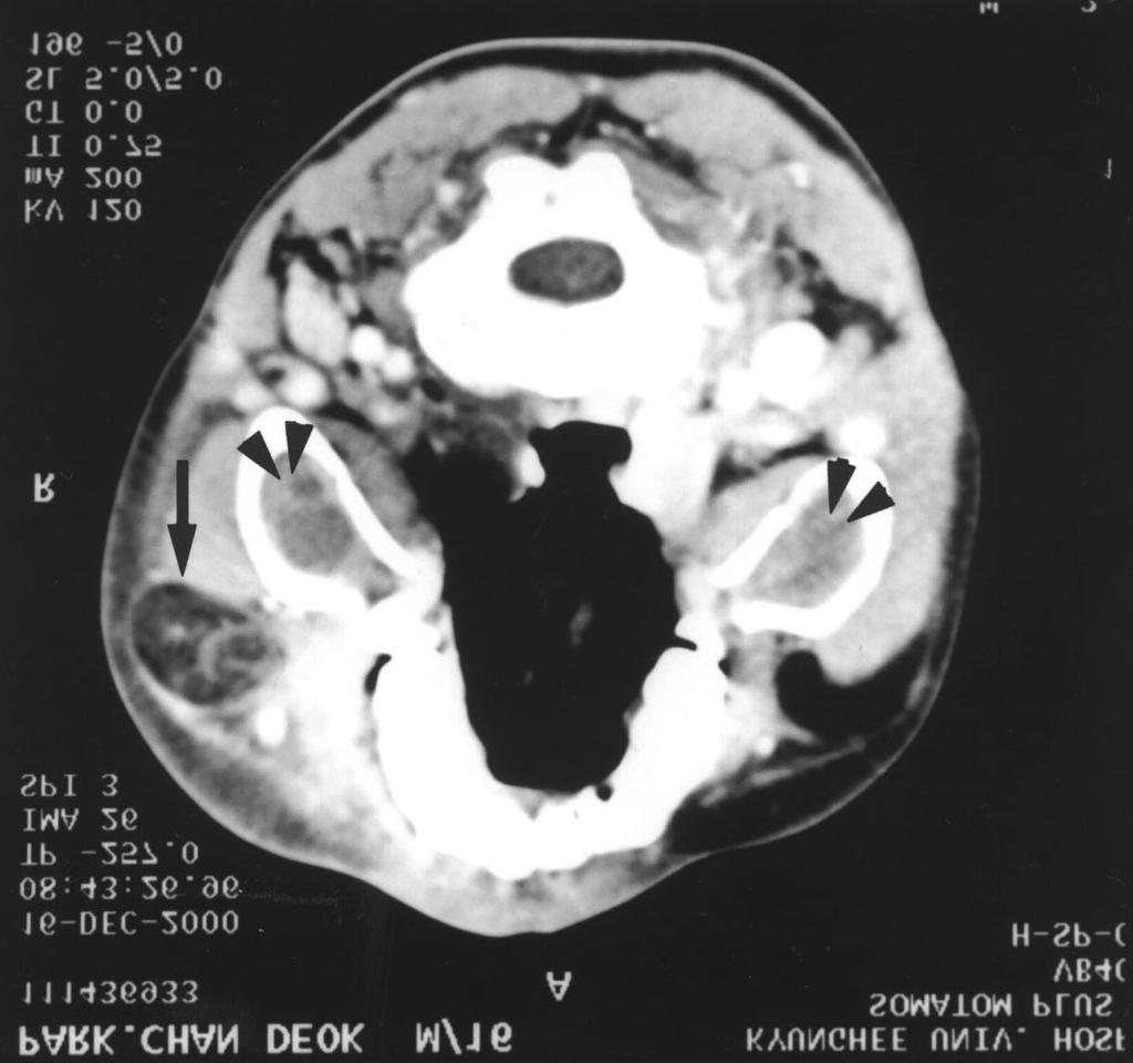 Infected odontogenic cyst filled with low density material and gas is seen in the right maxillary sinus (arrows) and right cheek is swelled diffusely.