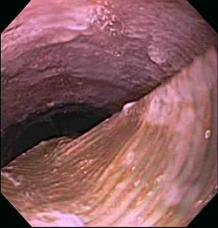 Eosinophilic esophagitis