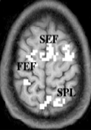 이과정을 Corbetta는 circuit-breaking 기능이라고하였고이때활성화되는뇌부위는우측하부전두엽 (ventral frontal cortex, VFC) 과측두엽-두정엽연접부위 (temporoparietal junction, TPJ) 이다 (Fig. 5).