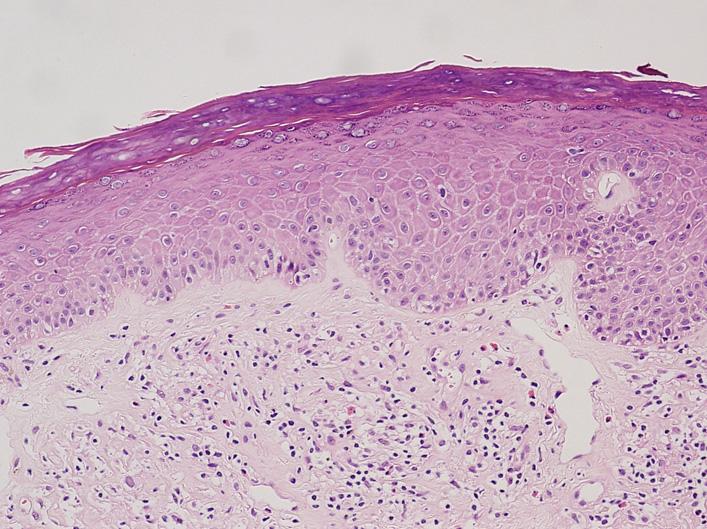 showing pronounced edema underlying an atrophic epidermis with