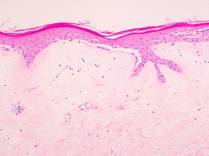 extragenital lichen sclerosus et atrophicus  loss of rete ridges