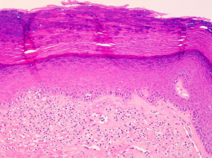 atrophicus showing narrow zone of edema and homogenization of