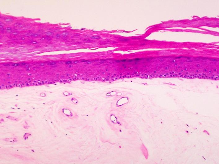 atrophicus showing band-like homogenization in the papillary