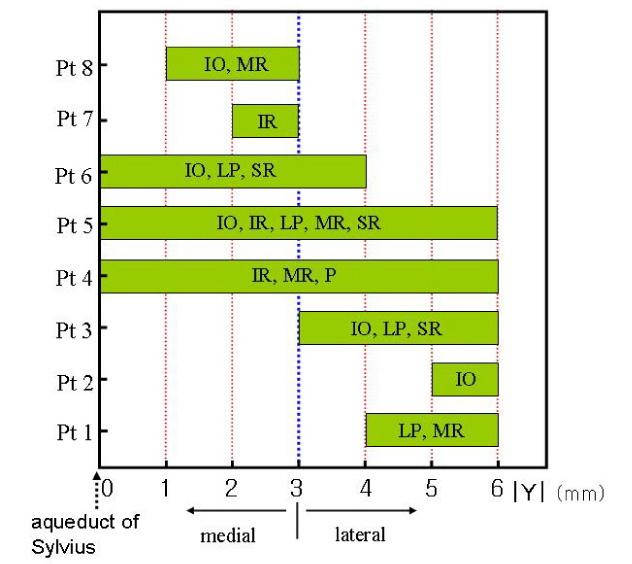 3D-Model of Oculomotor Fascicles in Midbrain IO, inferior oblique; IR, inferior rectus; LP, levator palpebrae; MR, medial rectus; P, pupil constrictor; SR, superior rectus Fig. 4.