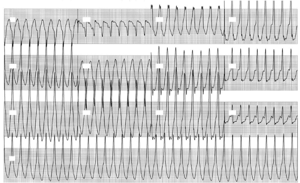 revealed positive QRS in the precordial and inferior leads.