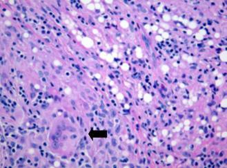 The mass is consisted of histiocytes, epitheloid cells and multinucleated giant cells (arrow). The mass has also numerous empty vacuoles. The mass was diagnosed as foreign body inflammatory granuloma.