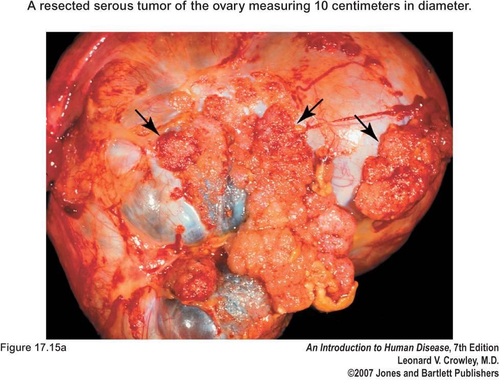 Ovarian Tumors Cystadenoma