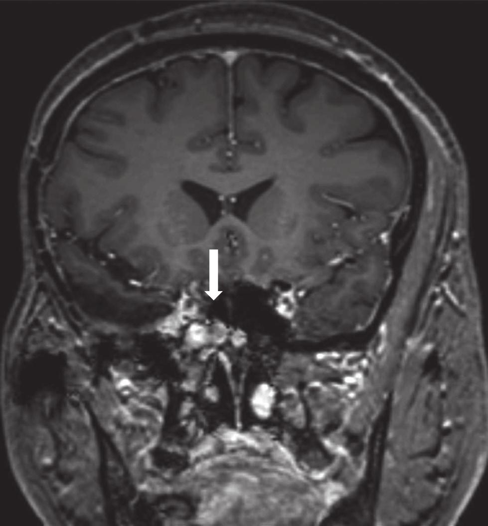 MRI at 5 years after tumor surgery (T1-Gadolinium