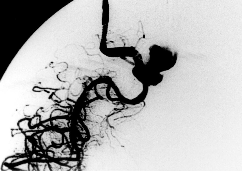 B Lateral view of the right common carotid artery(cca) angiogram, taken twenty eight days after balloon occlusion of the aneurysm and right ICA followed by superficial temporal artery(sta)middle