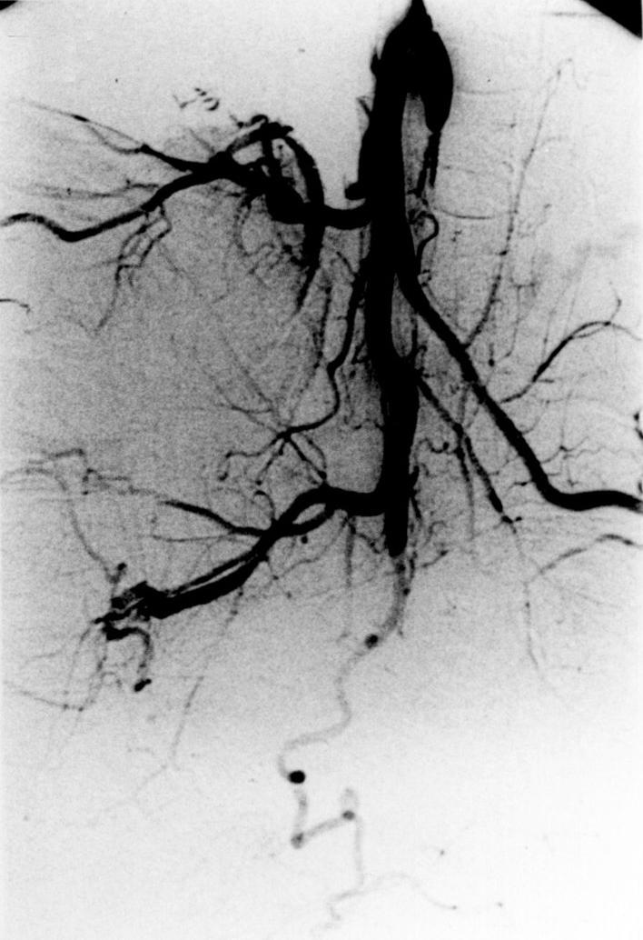 C Cross compression A-P view of the left ICA angiogram showing a collateral filling of the right anterior cerebral artery(aca) and CA through anterior communicating artery(a-com), and no filling of