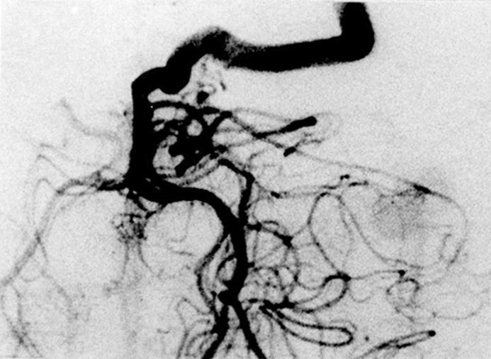 D & E Postoperative left and right angiograms, A-P views, taken 35 days after operation, showing complete disappearance of those