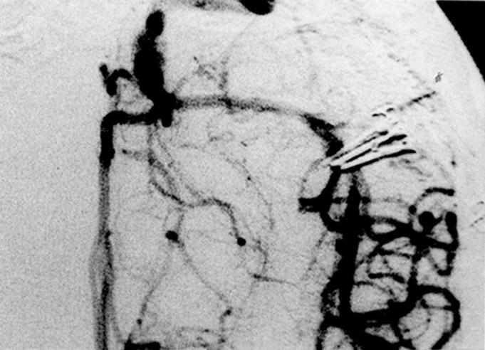 4B)가 발견되었으나, 기저동맥 분기부 에는 동맥류가 존재하지 않았다(Fig. 4C). 동맥류들을 1998 년 3월 17일 결찰하였다.