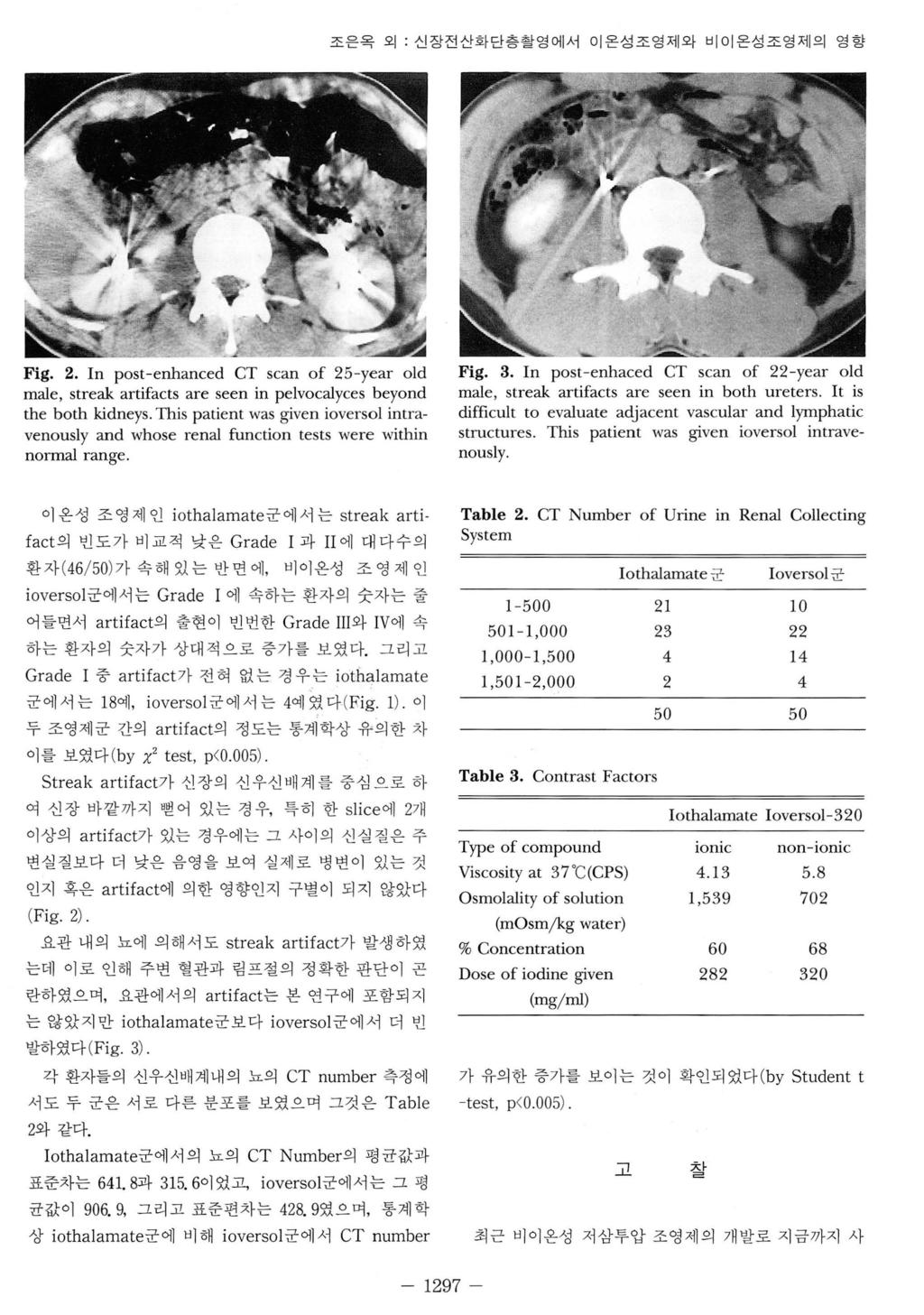 조은옥외 : 신장전산화단층촬영에서이온성조영제와비이온성조영제의영향 Fig. 2. In post-enhanced CT scan of 25-year old male, streak artifacts are seen in pelvocalyces beyond the both kidneys.