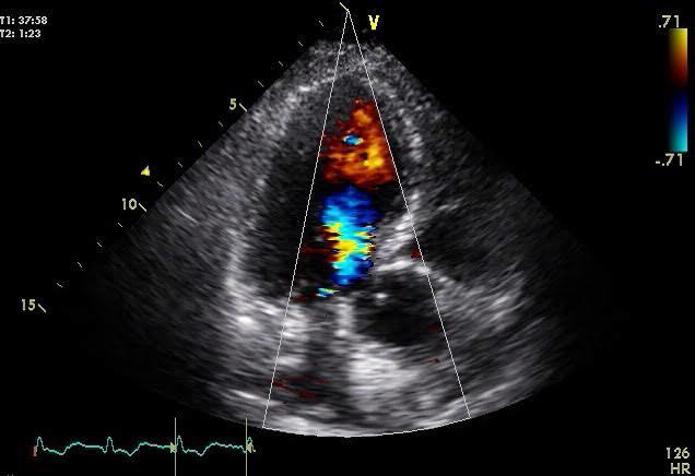 Dynamic Left Ventricular Outflow Tract Obstruction