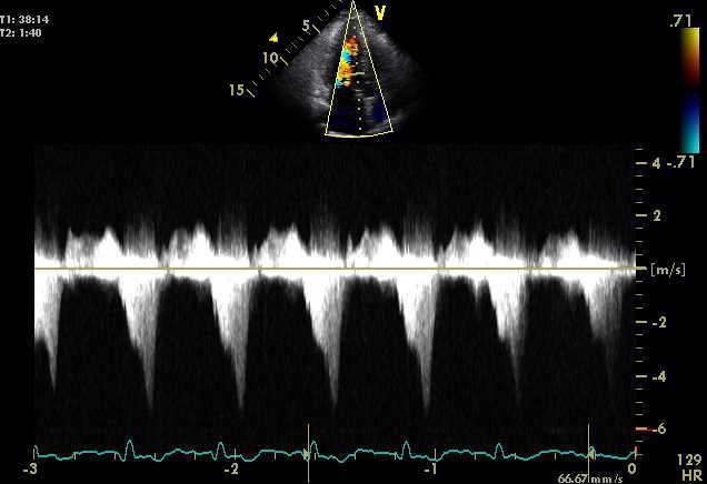 Anterior myocardial infarction In states of