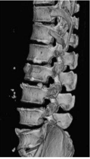 fracture by bone SPECT (right).