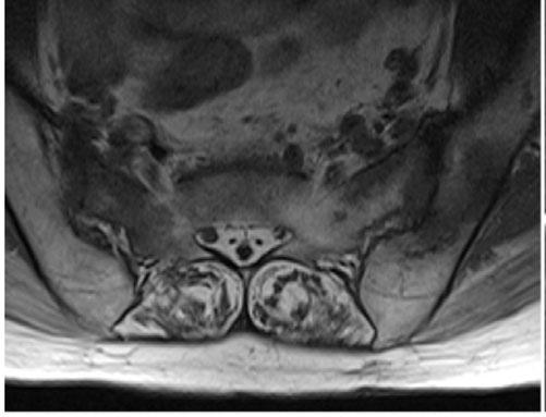 MRI finding of sacral