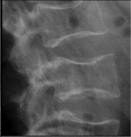 Simple radiographs of two cases