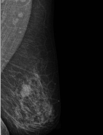 Craniocaudal and mediolateral oblique views of mammography show a circumscribed round