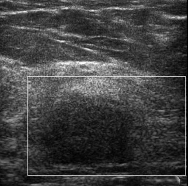 calcification. C, D. Transverse sonography shows about 2.