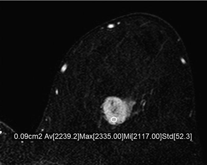 유방촬영술과유방초음파소견을통합하여최종범주 4A로이에대하여초음파유도하코어침생검 (ultrasonography guided core needle biopsy) 을시행하였고침윤성암 (invasive carcinoma) 으로진단되었다.