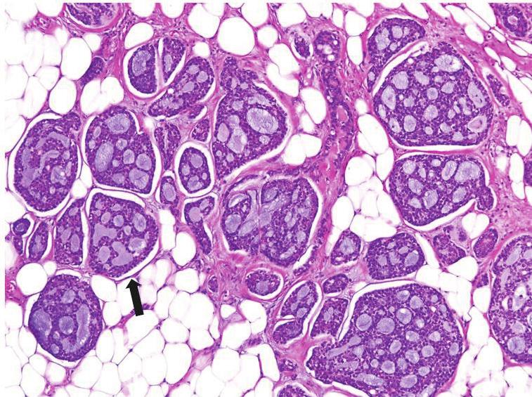 김정규 외 A B C D Fig. 4. Microscopic findings of pathologically confirmed adenoid cystic carcinoma. A. The mass is mostly consisted of small basaloid cells.