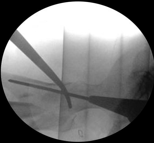 골수정삽입후에굴곡변형이재발하는경우에는대퇴골경부와두부로향하는유도핀을삽입한후에지혈감자를제거할수있다. 대퇴골두에지연나사가삽입되면근위골편의고정은안정적이며원위골편의고정만남는다.
