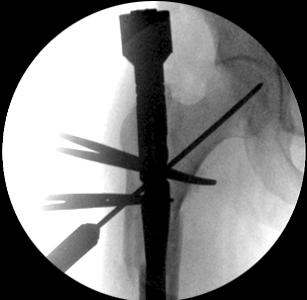 With the distal interlocking holes circular (arrow) and posterior margins of both femoral condyles exactly overlapped in the lateral view (B), nail geometry can be used to get a correct rotational