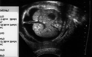 ascies/hepatosplenomegaly hydrops fetalis large placenta <Benacerraf, Ultrasound of fetal syndrome.