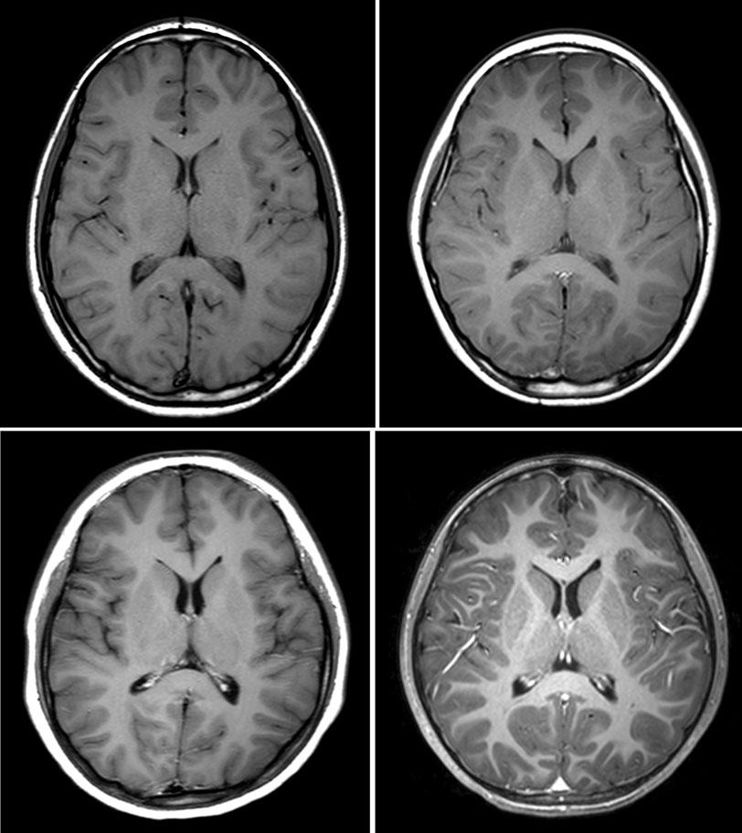 Goo HW C Figure 1. xial T1-weighted brain magnetic resonance (MR) images. Compared with a spin-echo image (repetition time msec/echo time msec, 543.8/15.0; flip angle, 90 ) at 1.