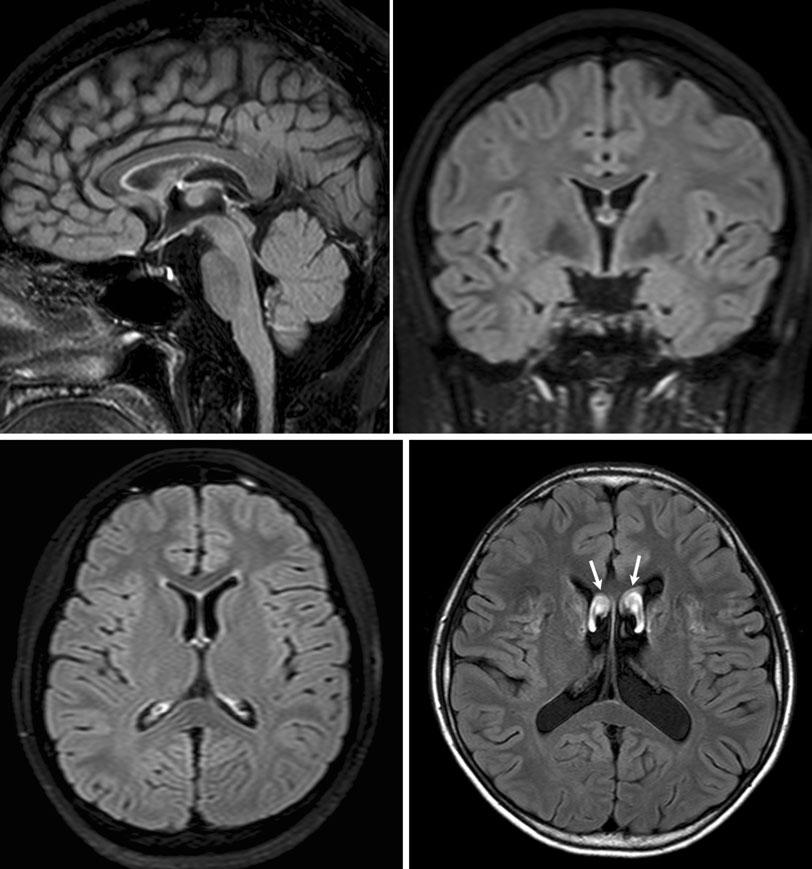High field strength magnetic resonance imaging in children C Figure 6. Fluid-attenuated inversion recovery (FLIR) brain magnetic resonance (MR) images.
