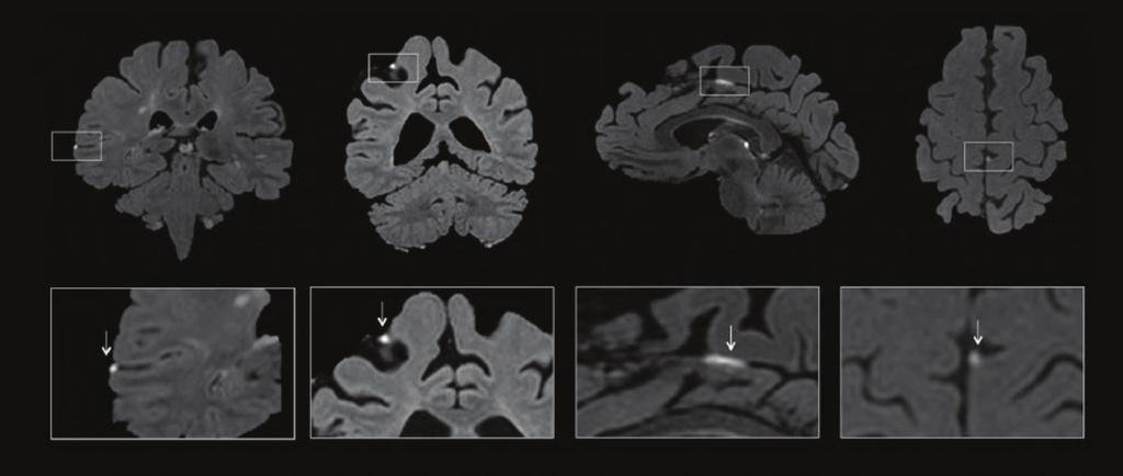 THE WINDOW OF MULTIPLE SCLEROSIS 정상인에서도발견될수있는소견들로확인되어제외하였다. 2명의경험많은 neuroradiologist 가병변의부위, 크기, 갯수, 모양, T1 조영증강후소견과의연관성등을분석하였다. In vivo 7T MRI 를 2명의진행성다발성경화증환자에게시행하고, 사후포르말린고정된뇌의병리소견을분석하였다. 그림 1.